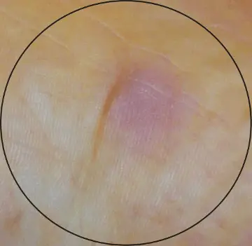 inflamed skin
