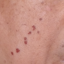 Natural Remedy to Mango Pulp Weevil Infestation: Evolution at Work? 2 burnt skin