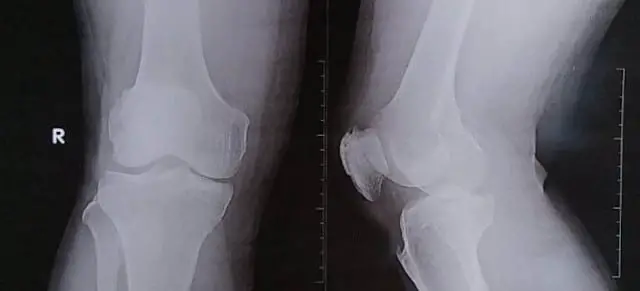 Knee Pain and Injury: 26 Days to Healing 1