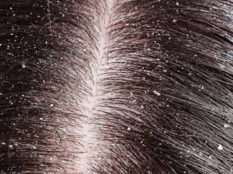 Dandruff Treatment: Two Natural Ways for Healthy Hair 1 dandrufftreatment